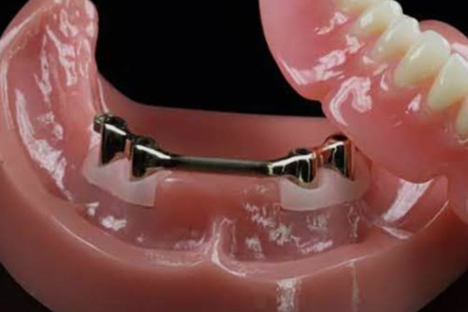 Over Denture
